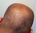 FUE donor scar1yr.jpg