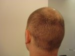 16 dagen 3021 grafts.JPG