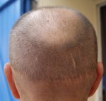 14 dagen 2671 grafts.JPG