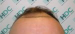 Pre Op Hairline 01-02-12 .JPG