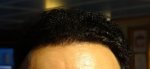 Hairline 12month result .jpg