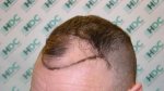 Pre Op Left Side 01-02-12.JPG