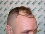 Pre Op Right Side 01-02-12.JPG