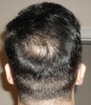 Crown 4 Months Post Op.JPG