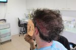2nd procedure 2.JPG