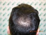 Pre Op Crown 08-10-12 0800rs.JPG