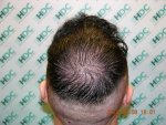 08-10-12 1203 Grafts Placed FUE 1800HRS.JPG