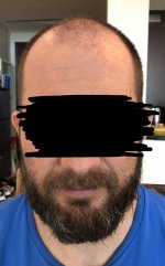 Dr John Cole hair transplant.jpeg