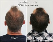 dieter v hair boost crown area.jpg