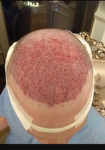 FUE hair transplant placement.jpg