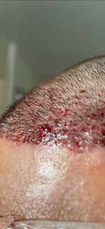 Dr. Cooley Hair Transplant1.png
