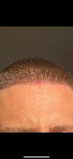 Dr. Cooley hair transplant2.png