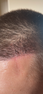 Dr. Cooley hair transplant4.png