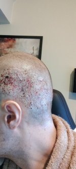 Day 1 after surgery donor 2.jpg