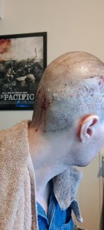 Day 1 after surgery donor.jpg