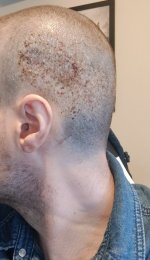 Day 5 Post Op 2.jpg Day 5 Post Op 2.jpg
