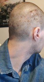 Day 5 Post Op 3.jpg Day 5 Post Op 3.jpg