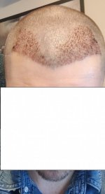 Day 5 Post Op Edit.jpg Day 5 Post Op Edit.jpg
