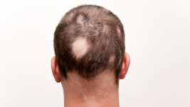 alopecia 2.png