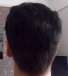 Crown Hair Combed back 6 month Dry.jpg