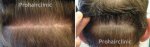 prohair smp scar correction2.jpg