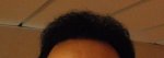 front hairline 15 month post op.jpg