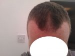 4 mths front loss.jpg