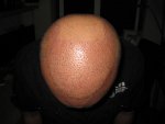surgery on 24052013-1.JPG