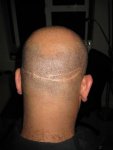 surgery on 24052013-2.JPG