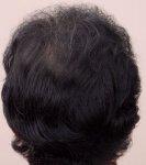 Crown 10 Months Post Op Flash Close up.jpg