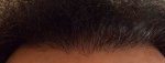 Hairline  18 months.jpg