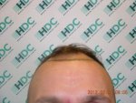 hairline Pre Op.JPG
