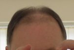 4 mths post transplant.JPG