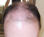 4 months post transplant2.JPG