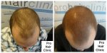 Chris before and after 2 sessions of SMP.jpg