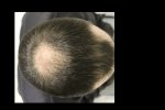 Hair 5 weeks 3.png.jpg