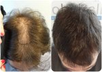 before and after ht and keratene.jpg