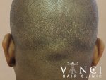 scalp pigmentation scars before.jpg