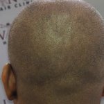 scalp pigmentation scars after.jpg