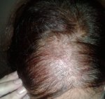 pre hair surgery.jpg