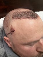Top of head - morning after III.jpg