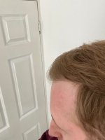 Post-op Hair - 6 months B.jpg