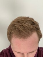 Post-op Hair - 6 months.jpg