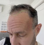 my hairline.jpg