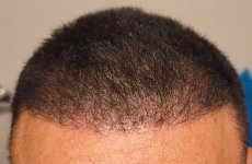 The-Best-Value-on-FUE-LA-Hair-Transplants.jpg