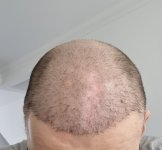 6 mth post surgery pic.jpg
