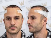 WMG London hairline FUE post op.jpg WMG London hairline FUE post op.jpg