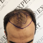 before-hair-transplant1.png