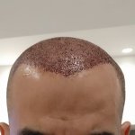after- hair-transplant(8 hours).jpg