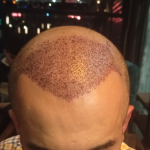 after- hair-transplant(2 days).png